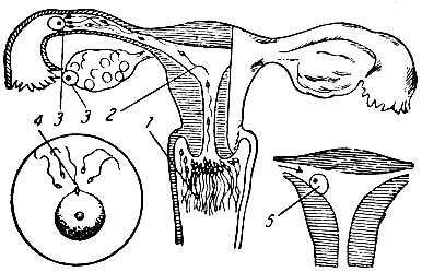 Рис. 8. Схема оплодотворения. 1 - мужское семя - сперматозоиды, попавшие во время полового акта во влагалище; 2 - сперматозоиды продвигаются через полость матки в трубу; 3 - зрелая яйцеклетка - женская половая клетка - выходит из яичника и попадает в трубу; 4 - при сильном, увеличении видно, что из многих сперматозоидов, достигших яйцеклетки, только один проникает в нее и происходит оплодотворение; 5 - оплодотворенное яйцо прикрепляется к стенке матки