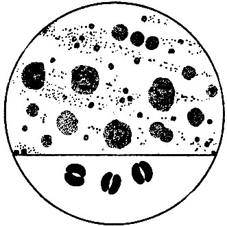 Рис. 9. Вид под микроскопом выделений из половых органов при гонорее