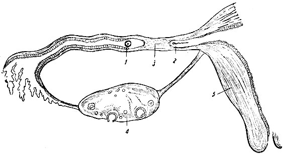 Рис. 11. Непроходимость трубы (схема). 1 - женская яйцеклетка; 2 - мужская семенная клетка; 3 - непроходимый участок трубы; 4 - яичник; 5 - часть матки