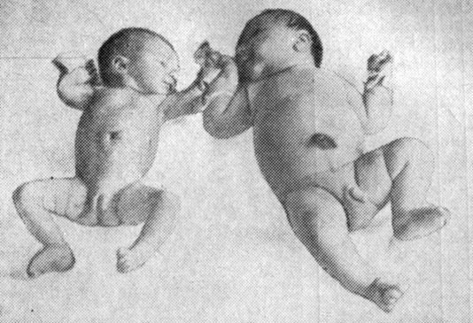 Рис. 4. Новорожденные от здоровой матери (слева) и больной сахарным диабетом (справа) (срок беременности 38 нед)