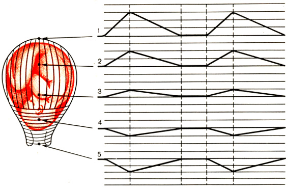 Рис. 12. Синхронность сокращения дна (1) и тела (2, 3) матки и одновременное, сопряженное, активное расслабление нижнего сегмента (4) и шейки матки (5), по данным наружной многоканальной гистерографии (схема)